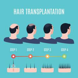 ปลูกผมและคิ้วด้วย FUE ( Follicular Unit Extraction )  Hair Transplantation by FUE